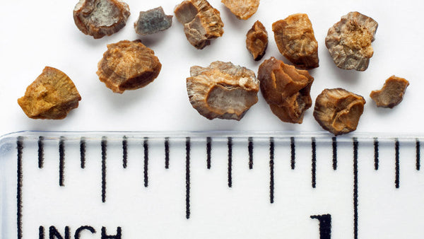 Picture of kidney stones next to a ruler